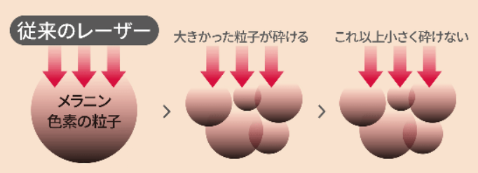 Qスイッチヤグレーザー