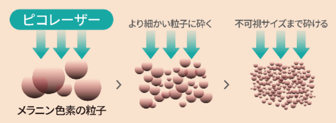 ピコレーザー